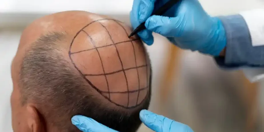 Bring Back Your Hair with PRP Hair Transplant